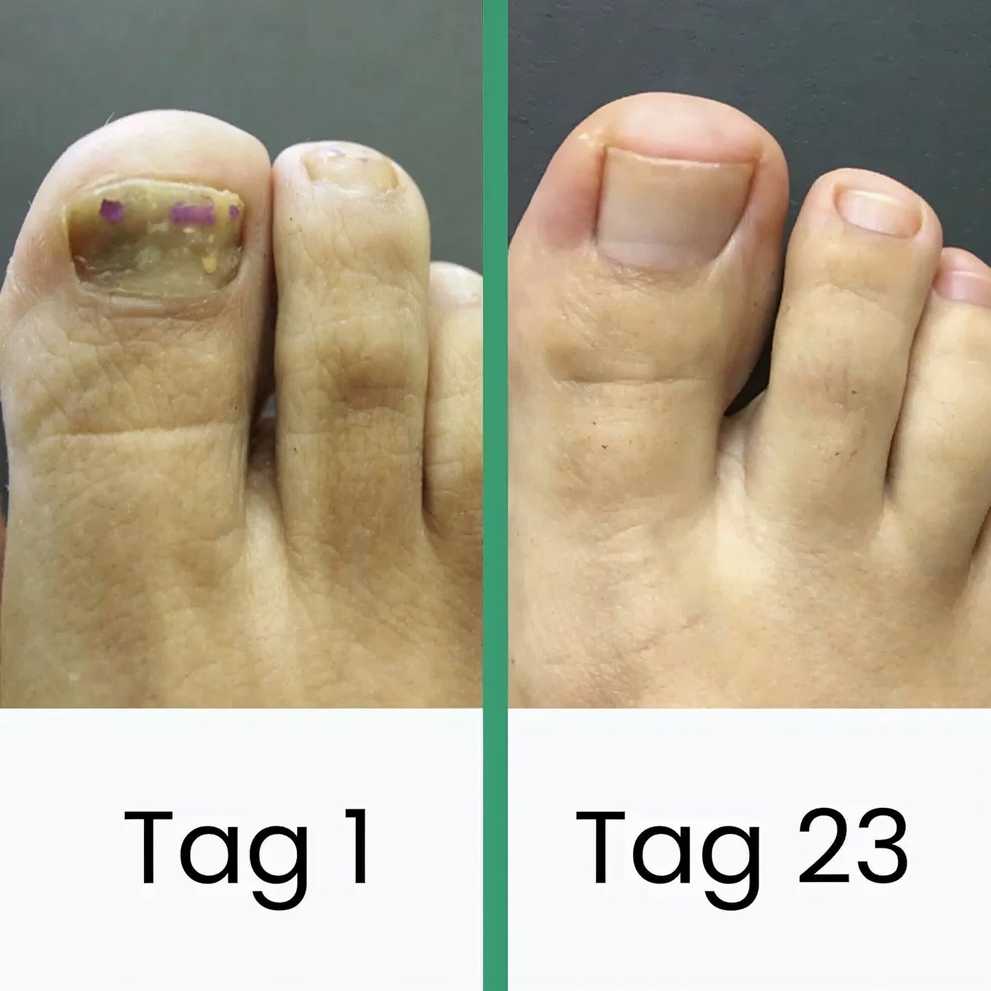 Schulz LLLT-Nagelpilztherapie