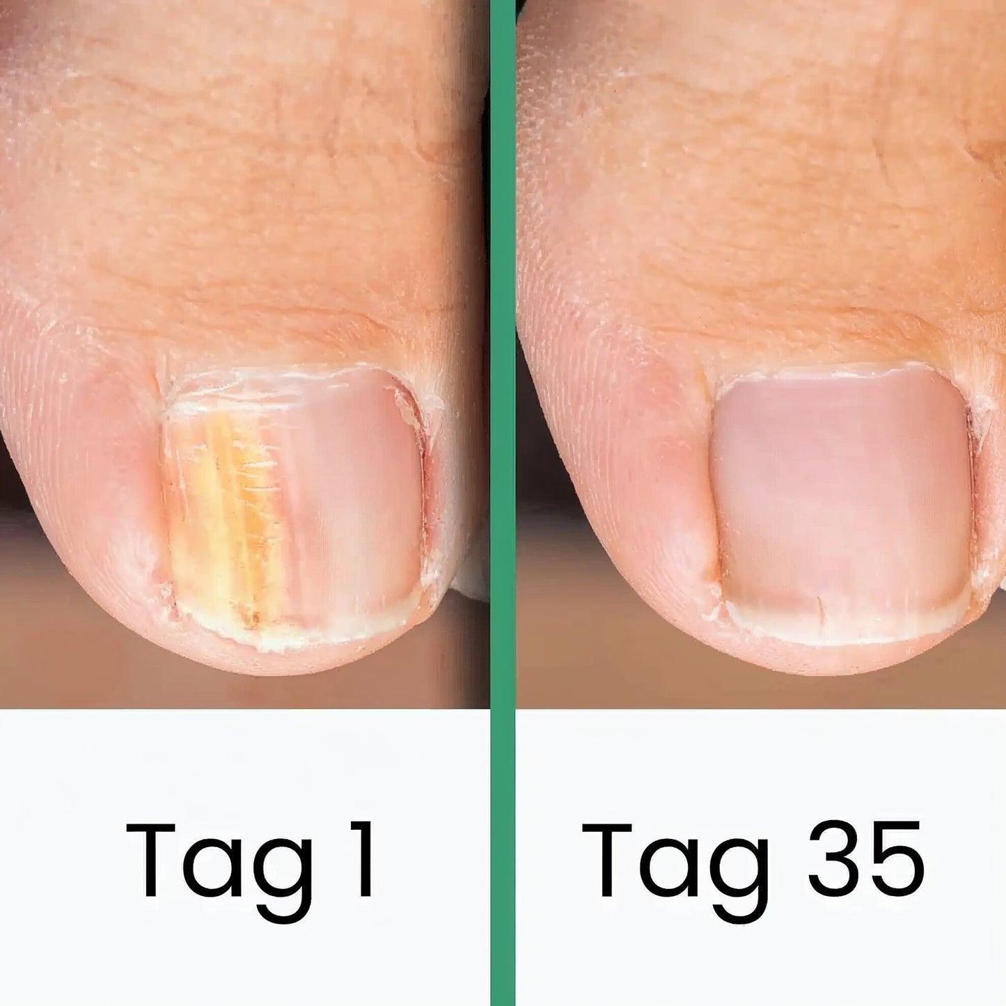 Schulz LLLT-Nagelpilztherapie